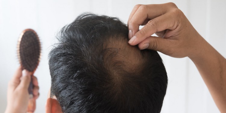 Los peligros del mercado negro en el trasplante de pelo