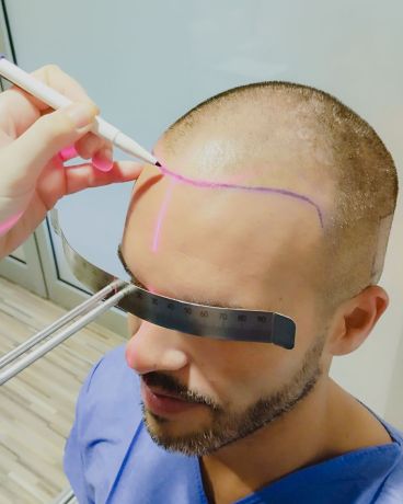 ¿Cualquier persona puede someterse a un trasplante de pelo?