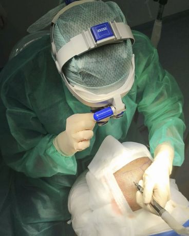 Aumento de casos de alopecia frontal fibrosante en Canarias