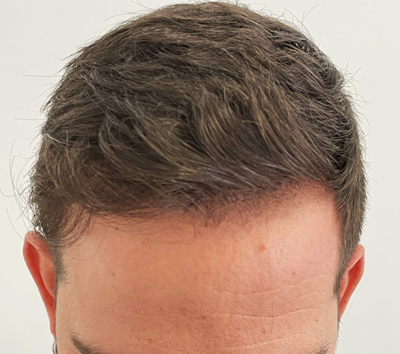 ¿Cuánto tiempo tardan los resultados de un trasplante de pelo en ser visibles?