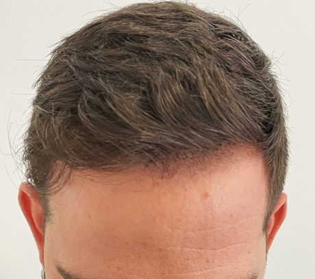 ¿Cuánto tiempo tardan los resultados de un trasplante de pelo en ser visibles?