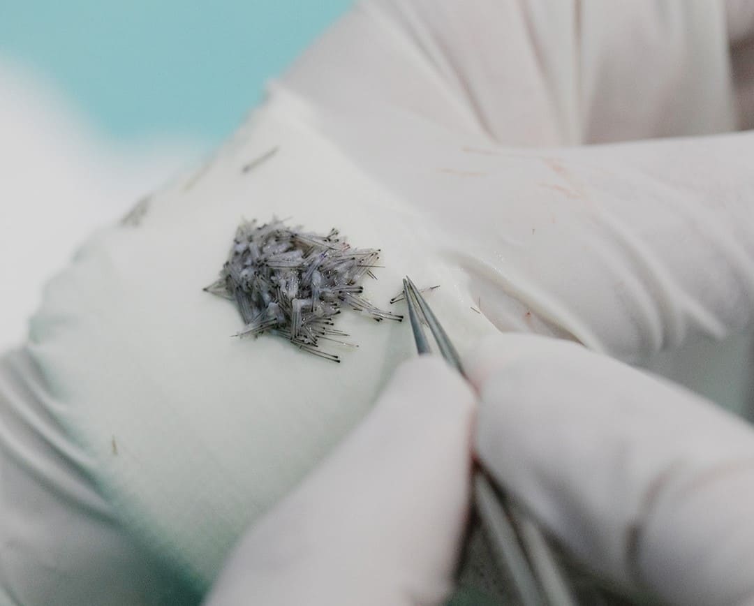 ¿Existe la posibilidad de rechazo del pelo trasplantado?