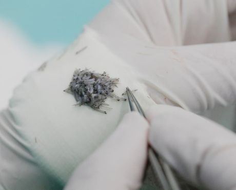 ¿Existe la posibilidad de rechazo del pelo trasplantado?