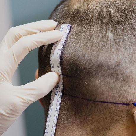 Trasplante capilar en cicatrices ¿Es posible?