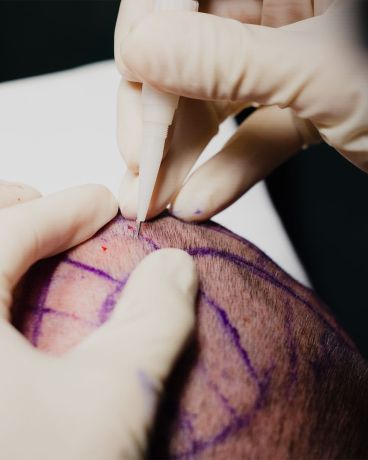 ¿Cuánto dura una sesión de trasplante de pelo en CapMédica?