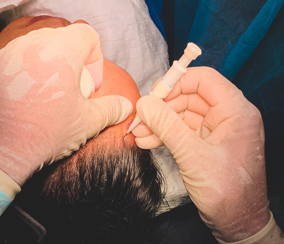 Trasplantes de pelo con instrumental miniaturizado: MicroFUE