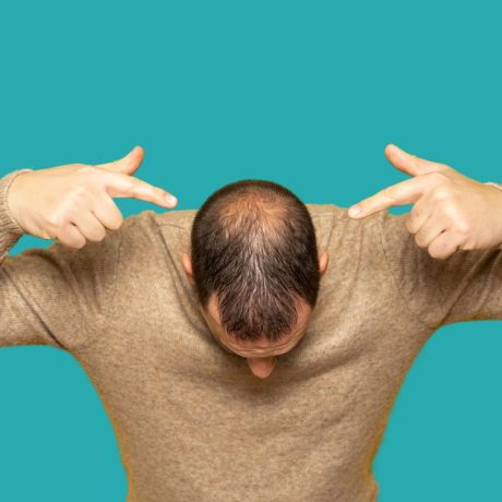 ¿Qué diferencia hay entre alopecia femenina y masculina?