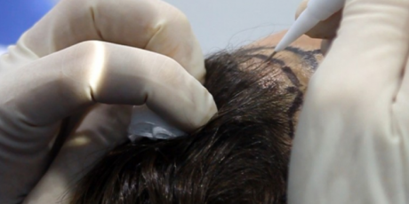 ¿Es doloroso el trasplante de pelo?