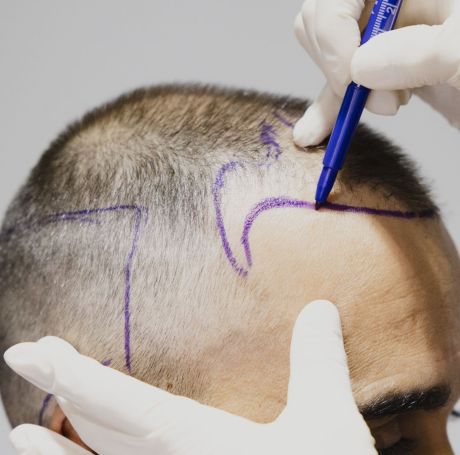 ¿El injerto capilar es el único método para recuperar el pelo perdido?