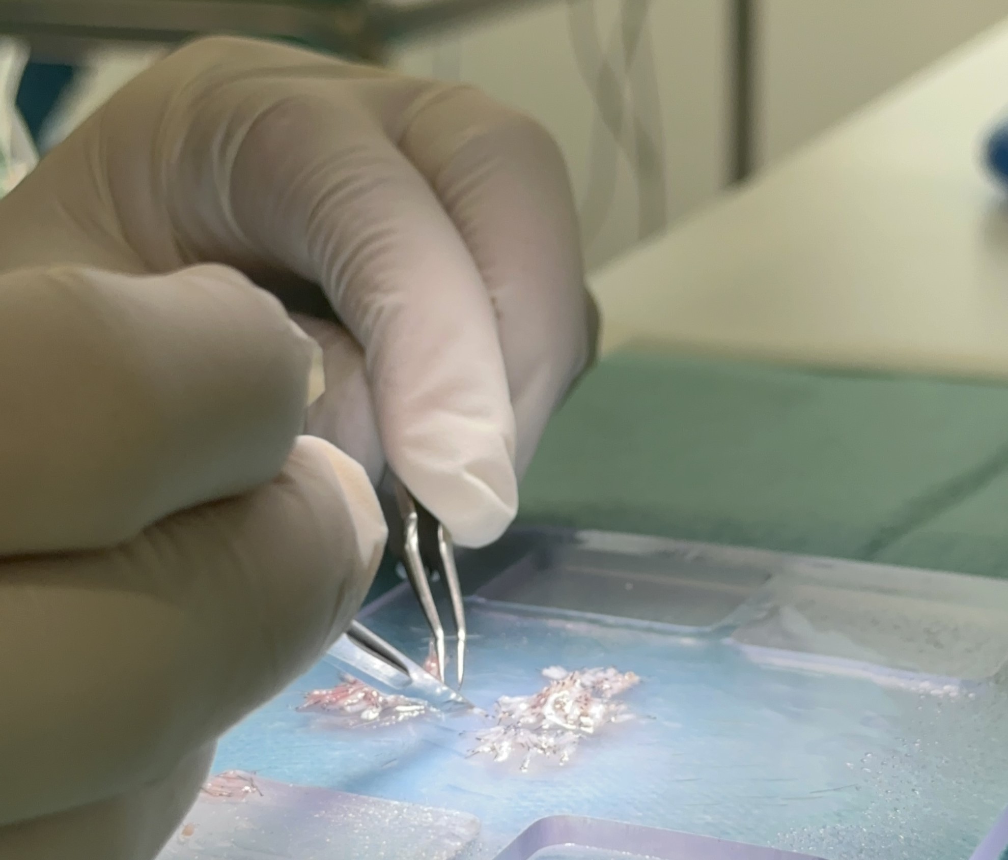 Guía útil sobre el trasplante de pelo