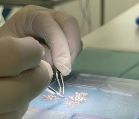 Guía útil sobre el trasplante de pelo