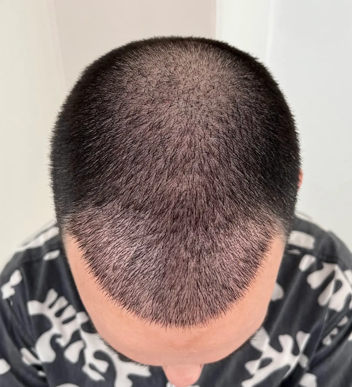 ¿La ronquina frena la caída del pelo? Análisis desde una clínica capilar