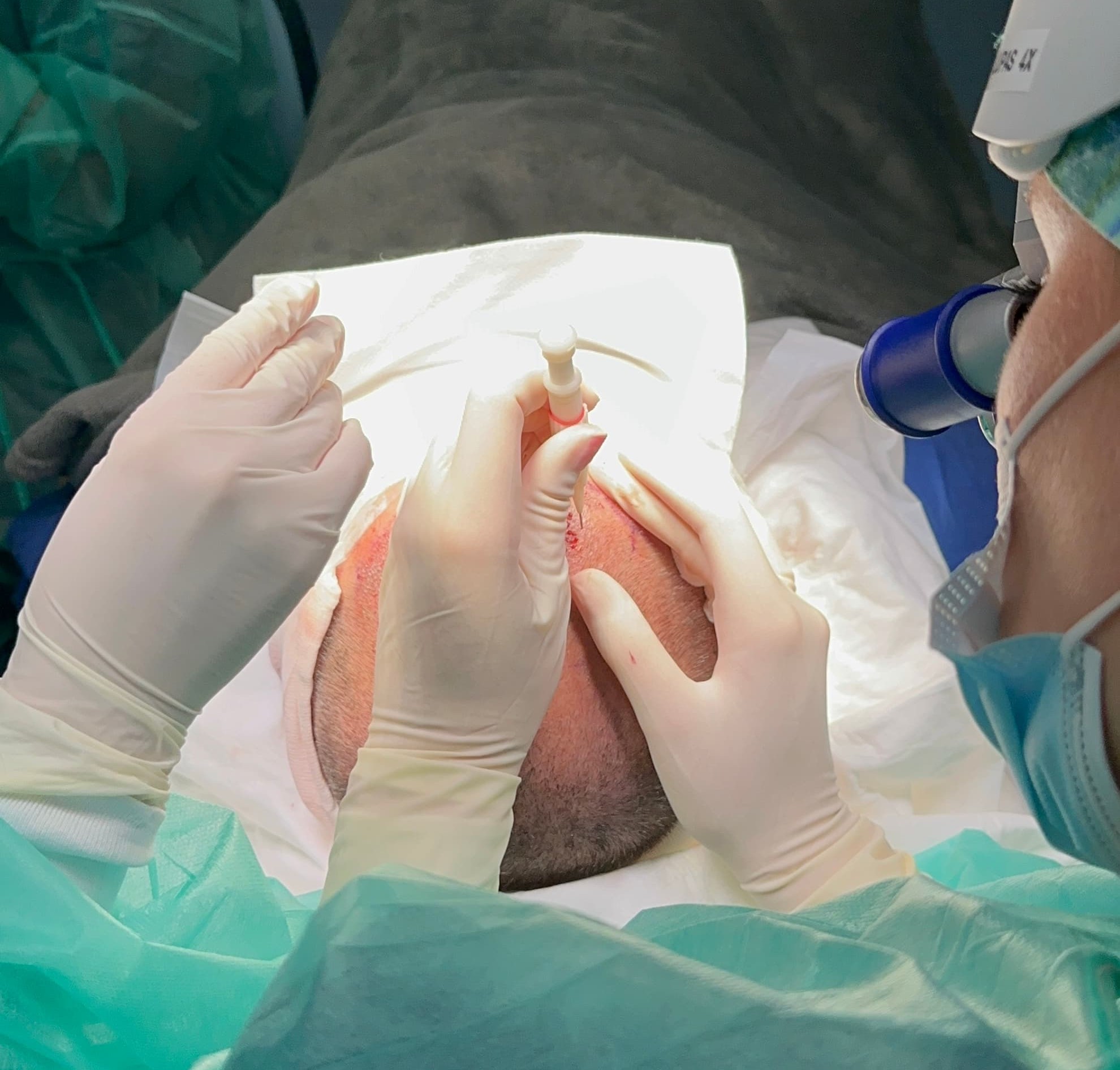 El trasplante de pelo con técnica FUE