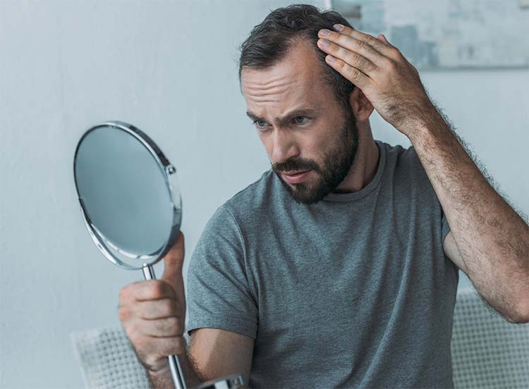 La alopecia androgenética la padecen hasta un 90% de los hombres