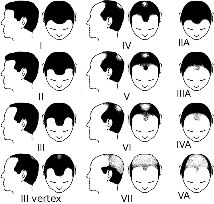 Grado de alopecia en hombres