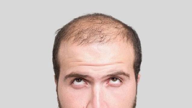 ¿Dónde puedes hacerte un trasplante de pelo inmediato en Canarias?