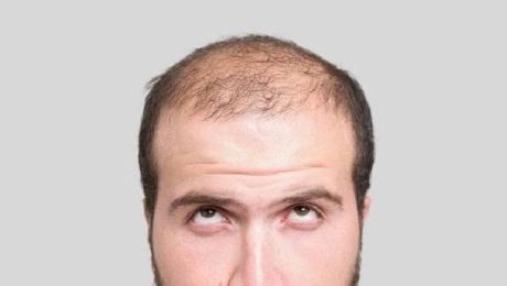 ¿Dónde puedes hacerte un trasplante de pelo inmediato en Canarias?