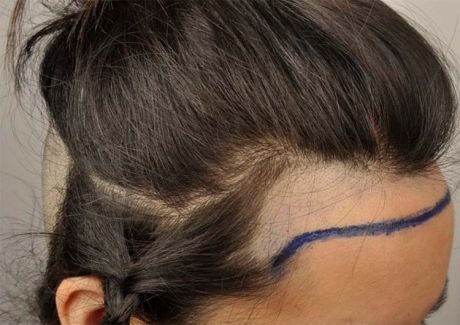 Modificación de la línea del pelo para disimular frentes anchas