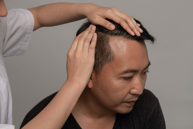 ¿De dónde procede el pelo que se injerta?