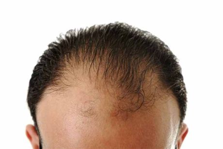 Guía sobre la alopecia: causas y tipos