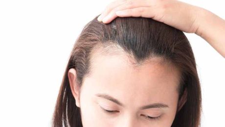 ¿Qué tratamientos existen contra la alopecia femenina?