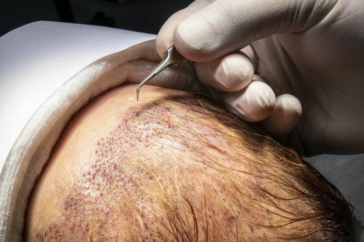 ¿En qué casos se recomienda realizar un trasplante de pelo?