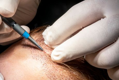 ¿El trasplante de pelo es doloroso?