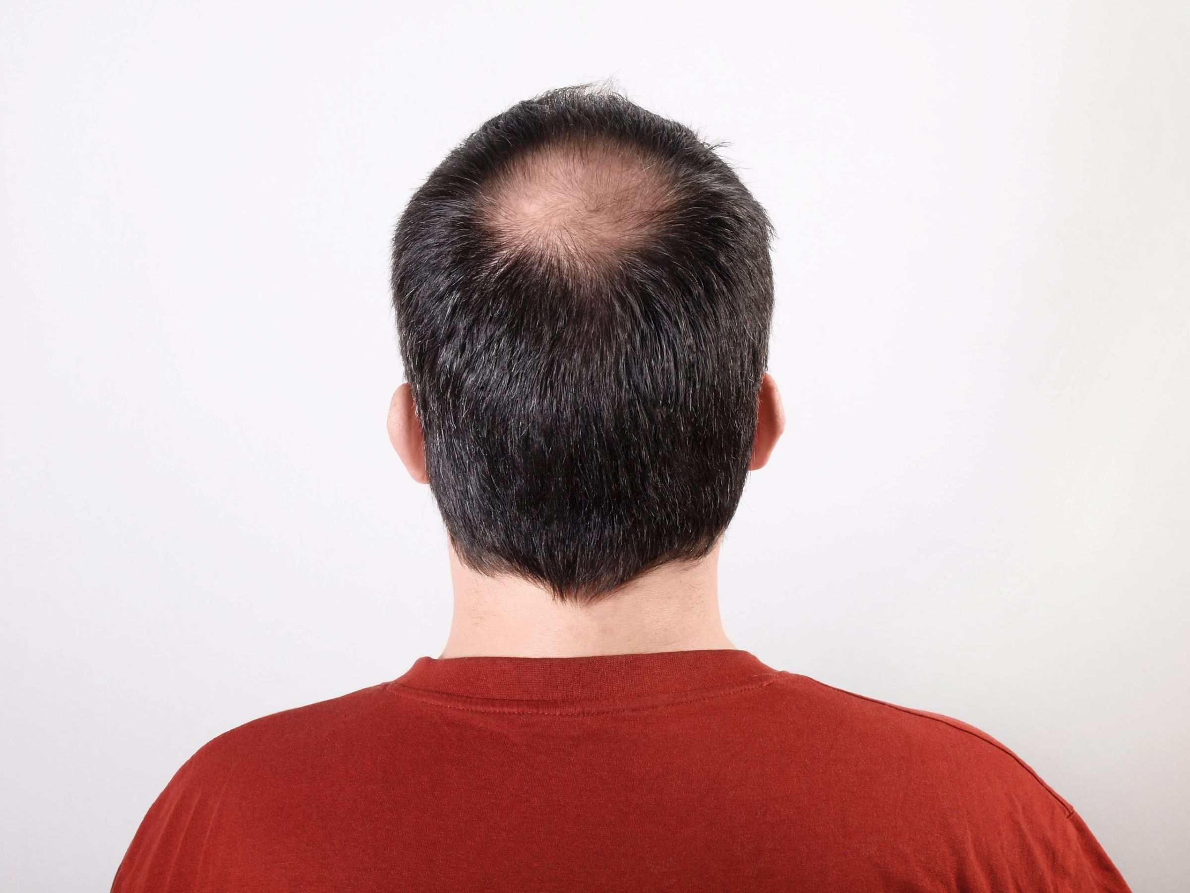 Complejidad del trasplante de pelo en la coronilla