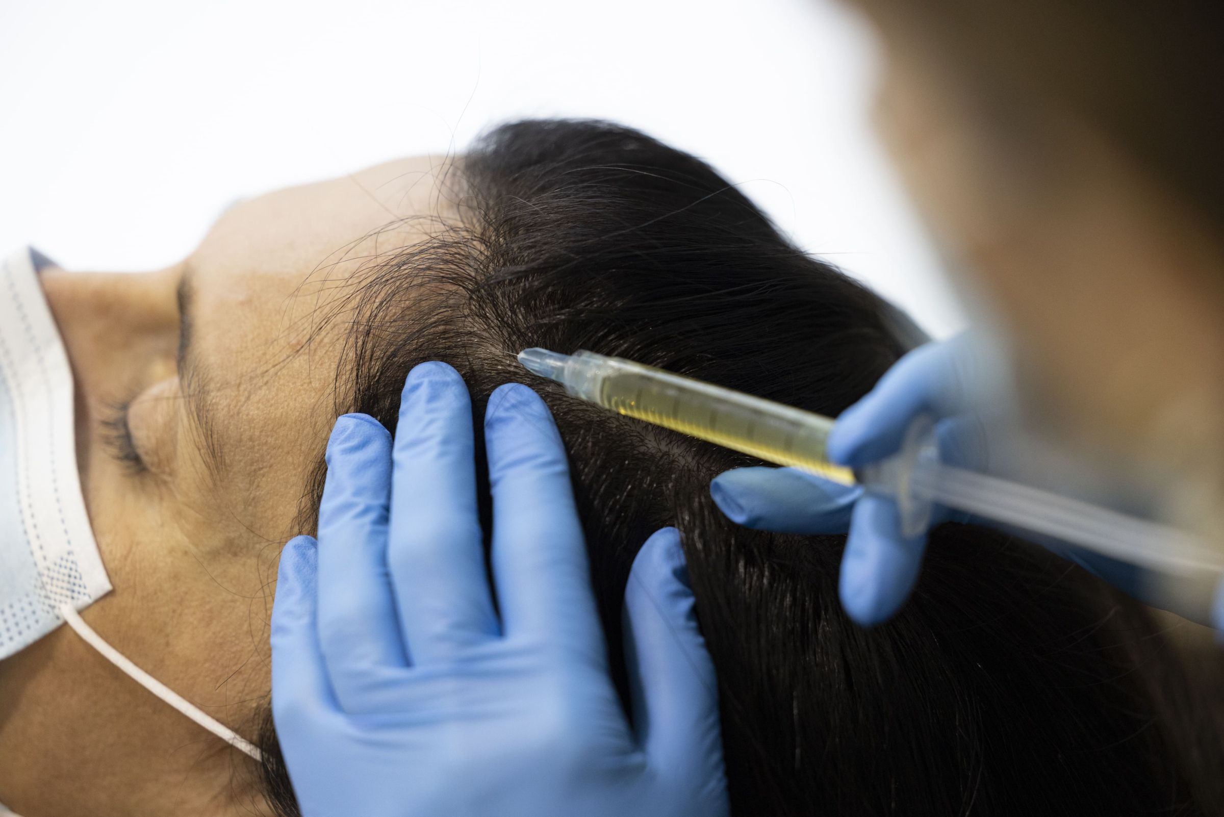 ¿Cómo se realiza la cirugía capilar FUE para mujeres?