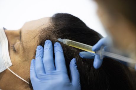 ¿Cómo se realiza la cirugía capilar FUE para mujeres?