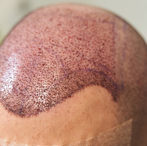 ¿Qué ocurre tras el trasplante de pelo?