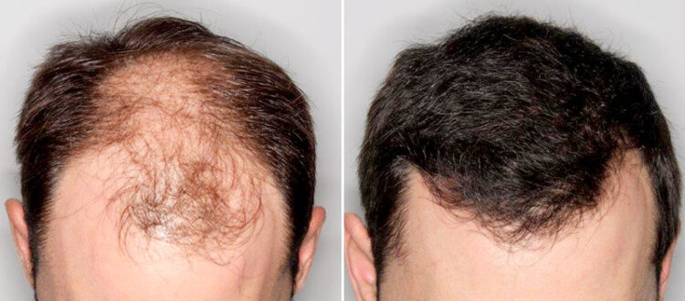 Trasplante de pelo, una solución eficaz a la calvicie