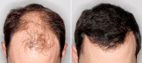 Trasplante de pelo, una solución eficaz a la calvicie