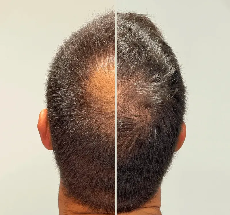 antes y despues tratamiento mesoterapia capilar