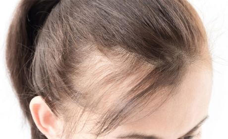 Diferencias entre trasplante de pelo femenino y masculino