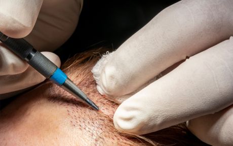 ¿En qué consiste el trasplante de pelo con la técnica FUE?