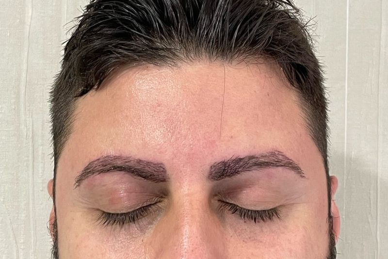 Hombre despues de un injerto capilar en sus cejas