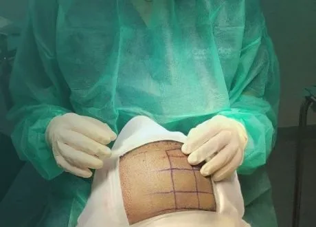 ¿Cómo se hace un trasplante de pelo?